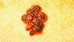 melanoma