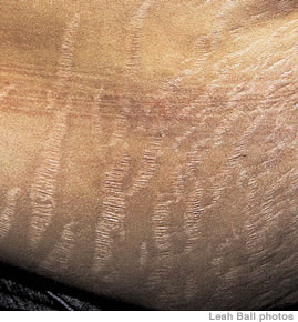 Stretch marks on a woman’s tummy after pregnancy