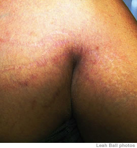 Stretch marks on a man’s upper arm and chest caused by weight lifting