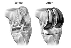 A damaged knee and a replacement